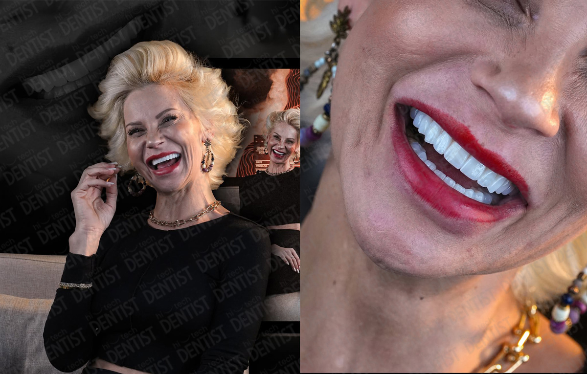 Smile Makeover